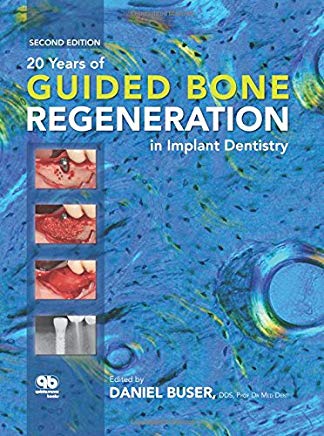 ۲۰Years of Guided Bone Regeneration in Implant Dentistry