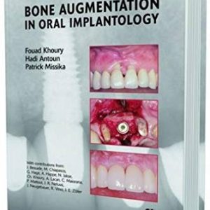 Bone Augmentation in oral implantology