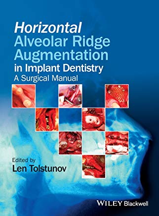 Horizontal Alveolar Ridge Augmentation in Implant Dentistry a surgical manual