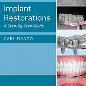 Implant Restorations A Step-by-Step Guide