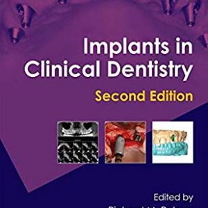 Implant in Clinical Dentistry