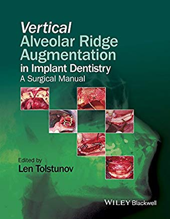 Vertical Alveolar Ridge Augmentation Implant Dentistry a surgical manual