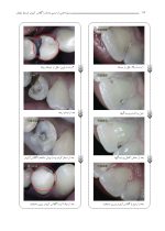 کاربرد کلینیکی گلاس آینومر (همراه با DVD آموزشی عملی) - Image 9