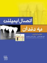 اتصال ایمپلنت به دندان