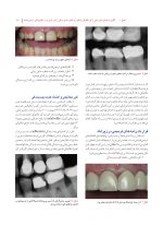 دندانپزشکی کم تهاجمی فوق لثه ای_Page_11 دندانپزشکی کم تهاجمی فوق لثه ای (یک رویکرد سالم تر در ترمیم های زیبایی) - Image 8