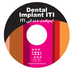 ایمپلنت دندانی ITI