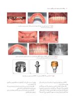 مشكلات جراحى ايمپلنت_Page_08 مشکلات جراحی ایمپلنت (علت، پیشگیری و درمان) - Image 8