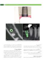 پروتز ایمپلنت های دندانی میش ۲۰۱۵ ج ۲ (سیاه و سفید) - Image 11
