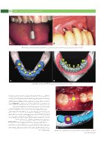پروتز ایمپلنت های دندانی میش ۲۰۱۵ ج ۲ (سیاه و سفید) - Image 12