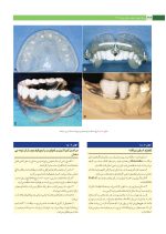 پروتز ایمپلنت های دندانی میش ۲۰۱۵ ج ۲ (سیاه و سفید) - Image 16