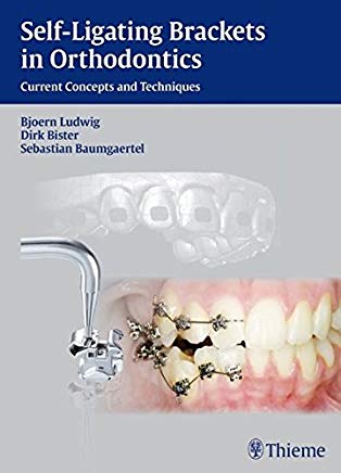 (Self-ligating Brackets in Orthodontics Current Concepts and Techniques (Thieme