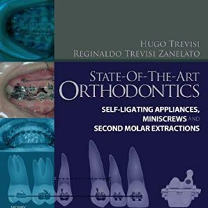 State-of-the-Art Orthodontics: Self-Ligating Appliances, Miniscrews and Second Molars Extraction