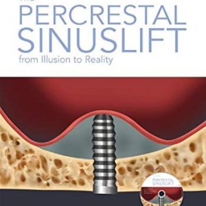The Percrestal Sinuslift From Illusion to Reality