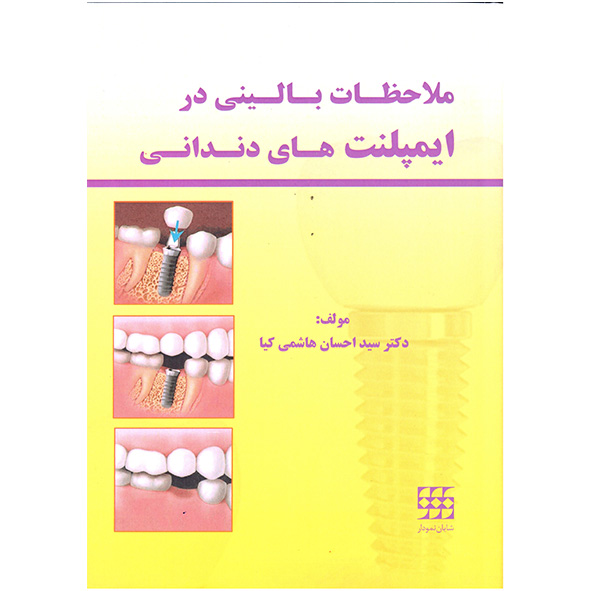 ملاحظات-بالینی-در-ایمپلت-های-دندانی