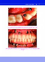 خطای کمتر در ایمپلنت - Image 7