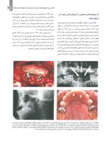 مبانی جراحی ایمپلنت های زایگوما (اصول دسترسی آناتومی) - Image 8