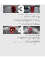 زیبایی شناسی بافت نرم و پرسلن های صورتی رنگ در درمان با ایمپلنت - Image 6