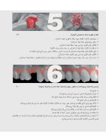 زیبایی شناسی بافت نرم و پرسلن های صورتی رنگ در درمان با ایمپلنت - Image 7