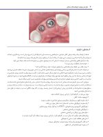عوارض پیچیده ی ایمپلنت های دندانی - Image 6