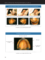 ساکشن فک پایین_Page_20 ساکشن پروتز کامل فک پایین به صورت "پیشرفته" - Image 9