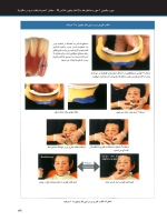 ساکشن فک پایین_Page_23 ساکشن پروتز کامل فک پایین به صورت "پیشرفته" - Image 10