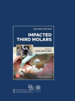 جراحی دندان عقل نهفته - Image 3