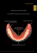 ساکشن پروتز کامل چیست؟ - Image 2