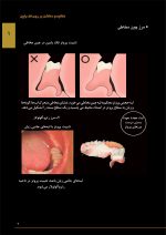 ساکشن پروتز کامل چیست؟ - Image 3