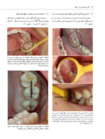 اطلس جراحی دندان عقل - Image 9