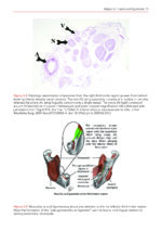 Transalveolar Extraction of the Mandibular Third Molars 2023 - Image 7