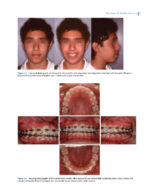 Dentofacial Orthopedics in the Growing Child 2023 - Image 8
