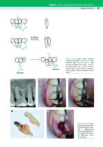 Bailey & Love’s Essential Operations in Oral and Maxillofacial Surgery 2024 - Image 11
