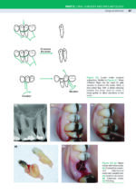 Bailey & Love’s Essential Operations in Oral and Maxillofacial Surgery 2024 - Image 11