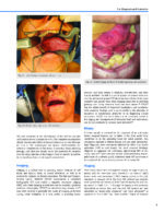 Oral Cancer: Evaluation, Therapy, and Rehabilitation 2020 - Image 3