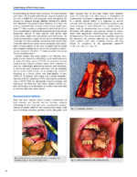 Oral Cancer: Evaluation, Therapy, and Rehabilitation 2020 - Image 4