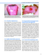 Oral Cancer: Evaluation, Therapy, and Rehabilitation 2020 - Image 6