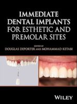 Immediate Dental Implants for Esthetic and Premolar Sites 2025