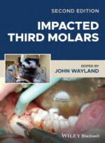 Impacted Third Molars 2024