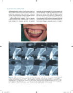 Immediate Dental Implants for Esthetic and Premolar Sites 2025 - Image 5