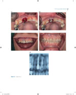 Immediate Dental Implants for Esthetic and Premolar Sites 2025 - Image 4
