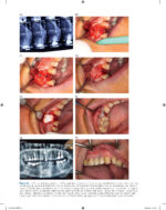 Immediate Dental Implants for Esthetic and Premolar Sites 2025 - Image 3