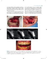 Immediate Dental Implants for Esthetic and Premolar Sites 2025 - Image 2