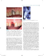 Immediate Dental Implants for Esthetic and Premolar Sites 2025 - Image 6