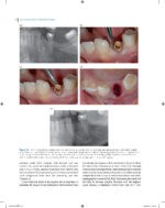 Immediate Dental Implants for Esthetic and Premolar Sites 2025 - Image 7