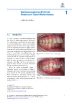 Orthodontic Management of Class II Malocclusion: An Evidence-Based Guide 2024 - Image 3