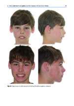 Orthodontic Management of Class II Malocclusion: An Evidence-Based Guide 2024 - Image 5