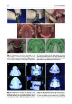Orthodontic Management of Class II Malocclusion: An Evidence-Based Guide 2024 - Image 6