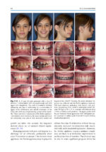 Orthodontic Management of Class II Malocclusion: An Evidence-Based Guide 2024 - Image 10