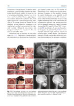 Orthodontic Management of Class II Malocclusion: An Evidence-Based Guide 2024 - Image 8