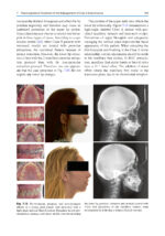 Orthodontic Management of Class II Malocclusion: An Evidence-Based Guide 2024 - Image 11